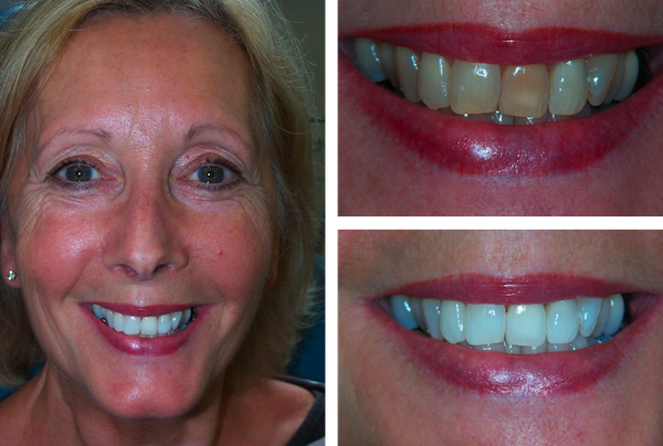 home laser teeth whitening kit reviews